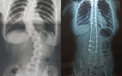 La scoliose, qu’est-ce-que c’est ?